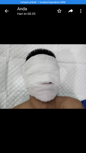 Wartawan Disiram Air Keras Di Wajahnya , Korban Masih Dalam Perawatan Di R.S Adam Malik